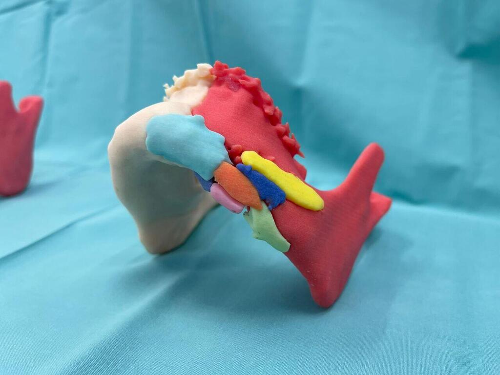 הלסת שהודפסה בתלת מימד. צילום: אסותא אשדוד