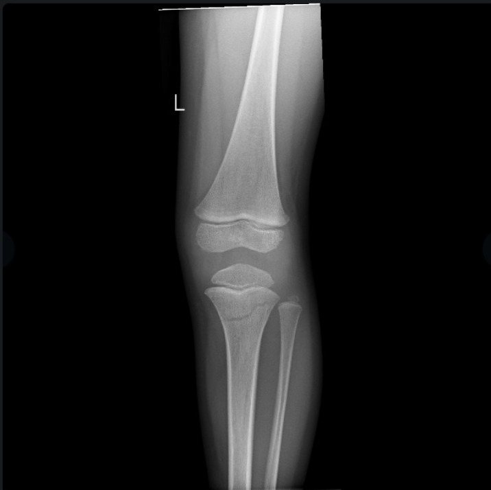 עצם של ילד שנשברה בעקבות נסיעה בקורקינט. אשכולות