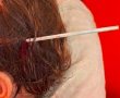 אמאל'ה: שיפוד מתכת ננעץ בראשה של הפעוטה